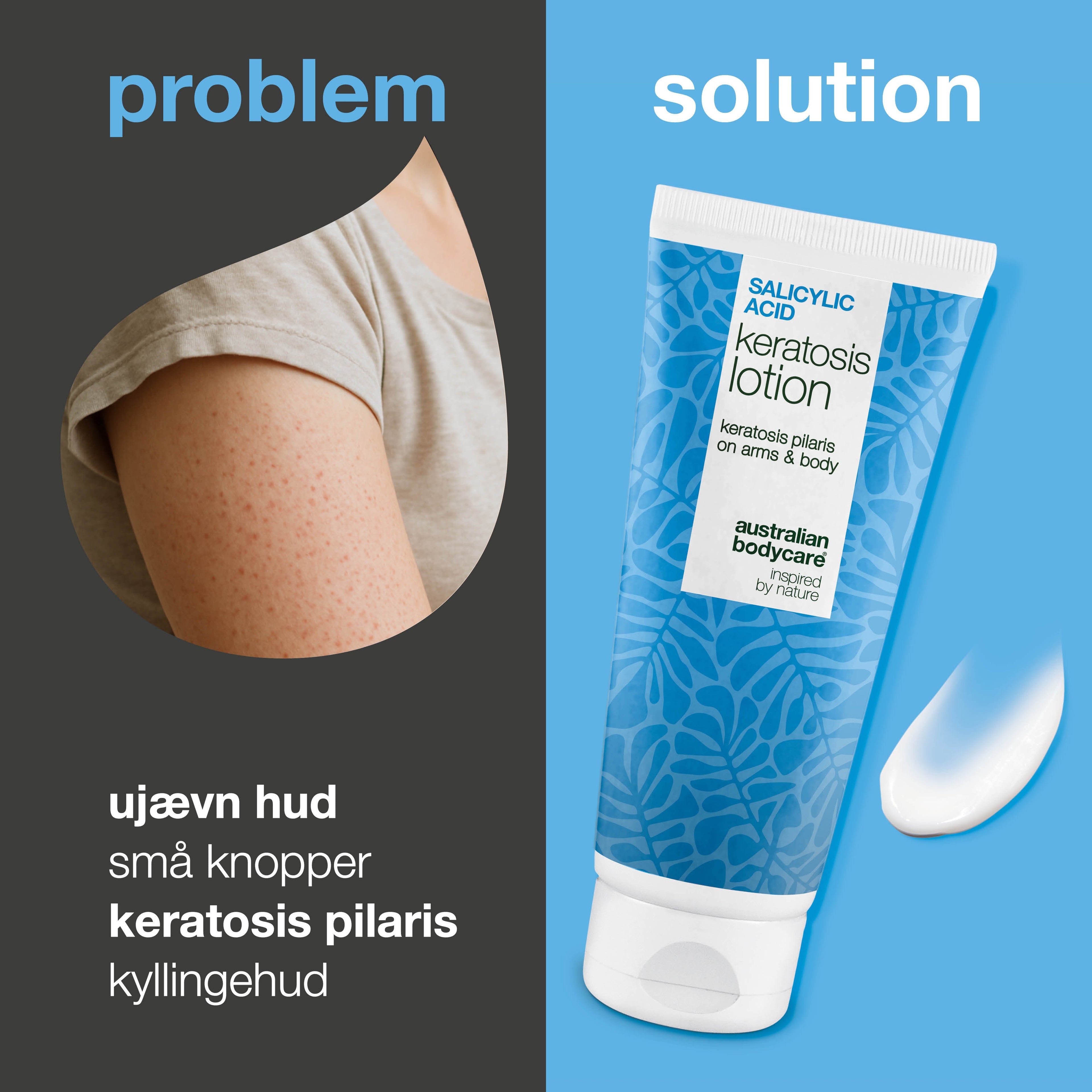 Body lotion mod keratosis pilaris og ru hud med små knopper — Body lotion mod keratosis pilaris og tør hud. Udglatter med salicylsyre, niacinamid og zink.