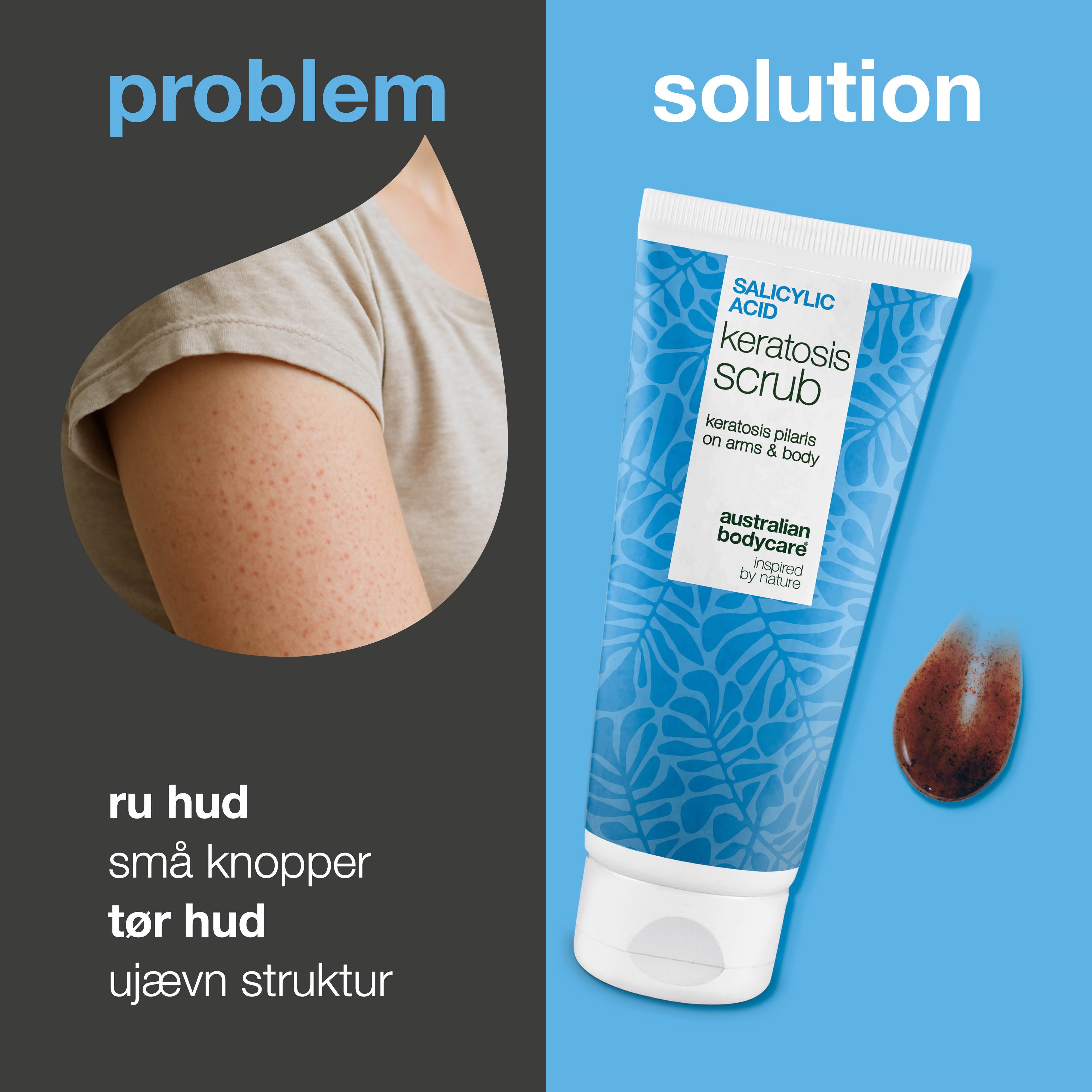 Keratosis Pilaris Body Scrub