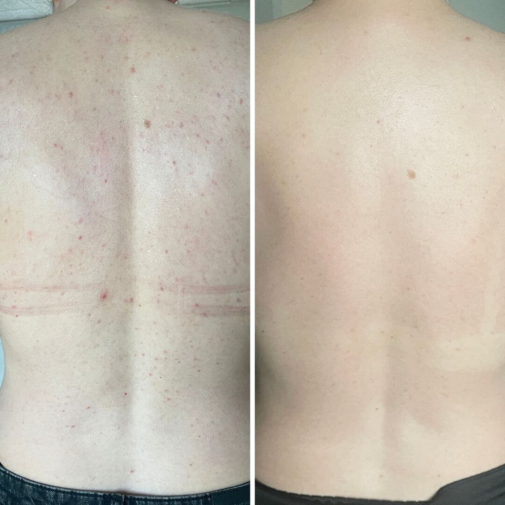 Salicylsyre spray mod bumser og uren hud på kroppen — Salicylsyre spray mod bumser og uren hud. Indeholder salicylsyre og glycolic acid, der renser porer og giver smuk hud.